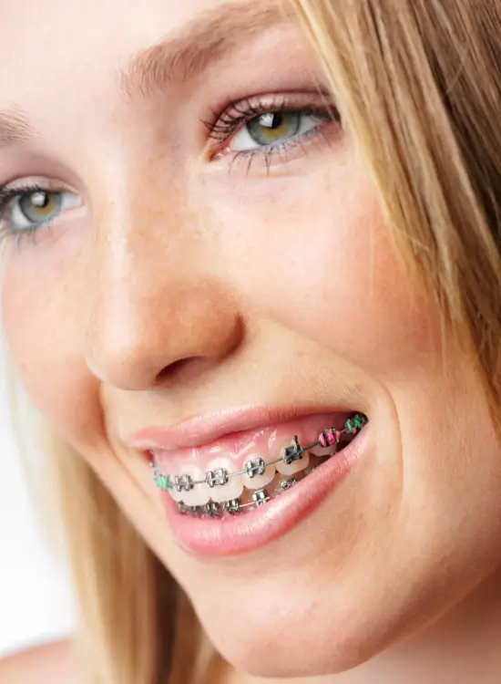 Close up of a teenage girl smiling with metal braces