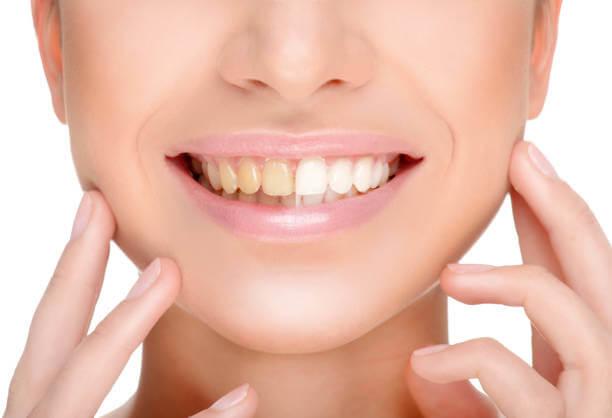 close-up shot of a woman's teeth before and after teeth whitening