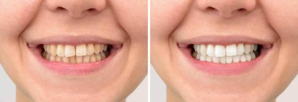 a close-up of a person's before and after teeth whitening