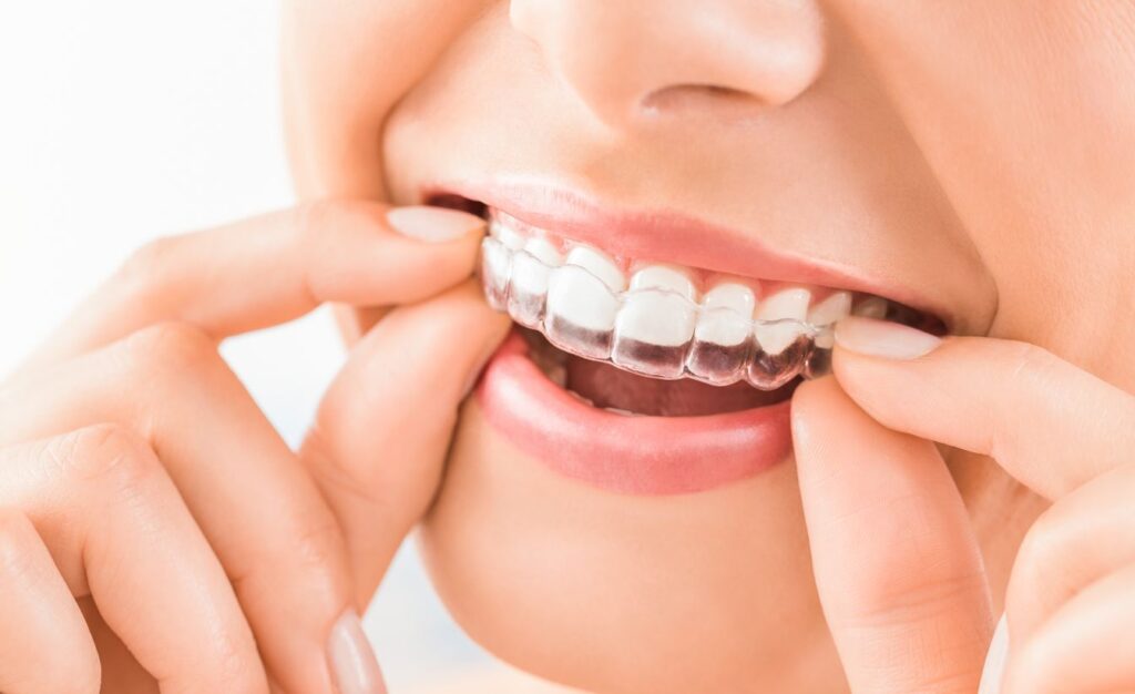 A woman putting on an Invisalign aligner