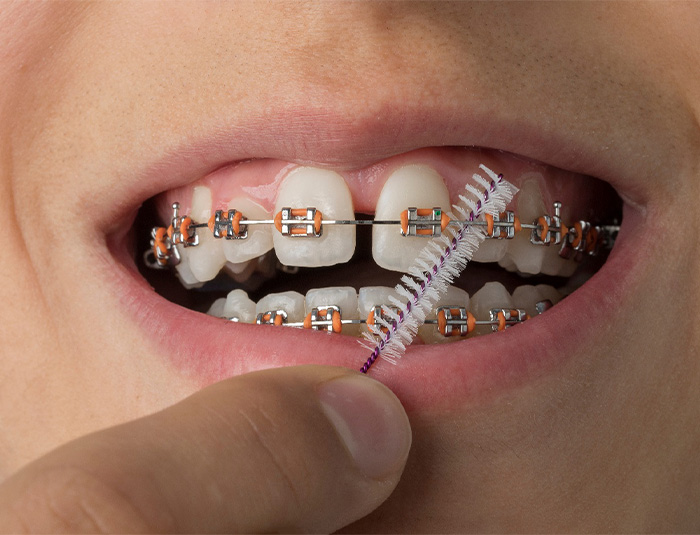 A closeup of teeth with traditional braces receiving brushing.