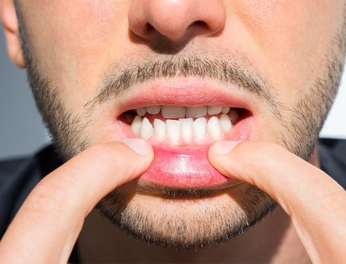 A young man revealing his crooked teeth.
