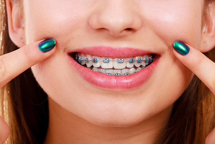 A young woman showing her teeth with traditional braces.