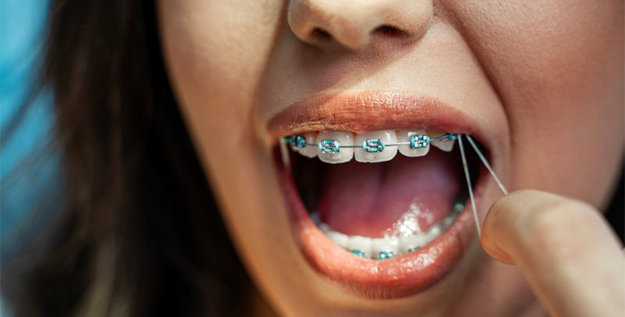 Teen manipulates elastics attached to her braces.